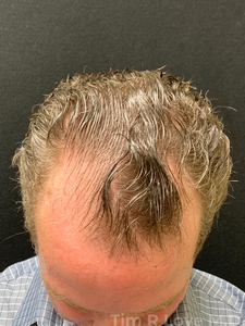 3000 grafts-before