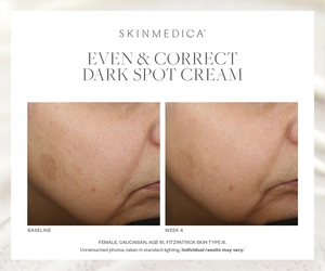 Even & Correct Dark Spot Cream-before