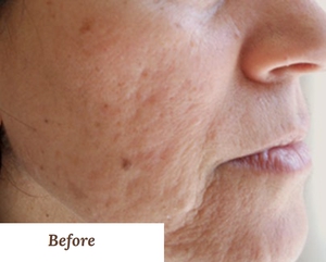 Post Acne Scars & Laxity-before