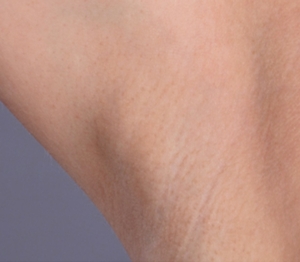 Laser Hair Removal #1-after