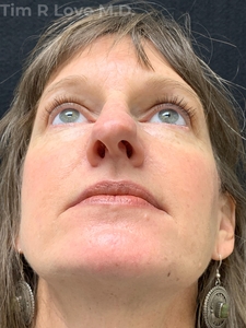 Rhinoplasty - Traditional-before