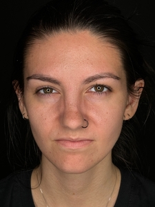 Tori Atkins RN. Treated with Xeomin.-after