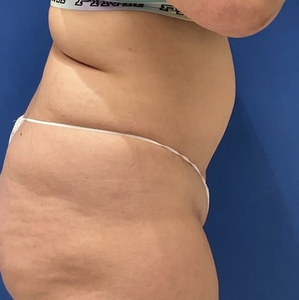 Tummy Tuck #9 (right)-after