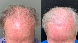 Nanofat/PRP 2000 Hair grafts-before