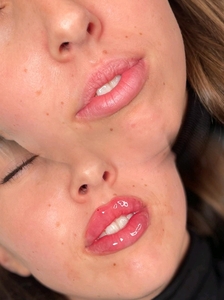 Lip Fillers-before