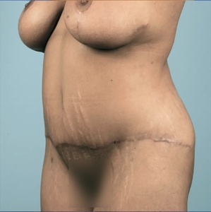 Mommy Makeover #4-after