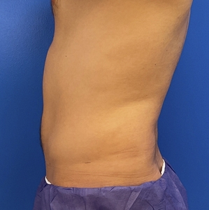 Liposuction #4-after