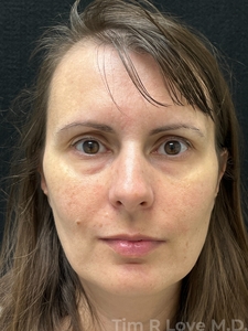 1 month post op Morpheus8 and Nanofat treatment x1-before