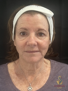 XERF one treatment-after