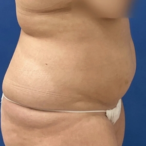 Lipo w Renuvion #2-before