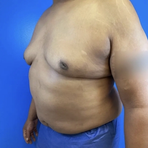 Male Breast Reduction #1-after