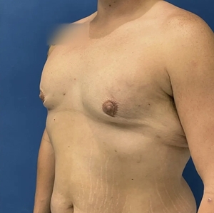 Male Breast Reduction #7-after
