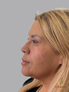 Cellenis Derma 11 ML kit, tear troughs and Cheeks-before