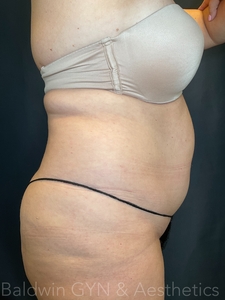 LIPO 2.0-before