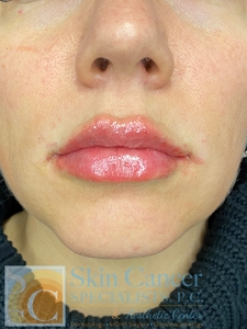 lip filler-after