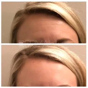 Botox-before
