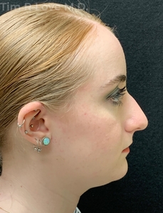 1 month post op-before