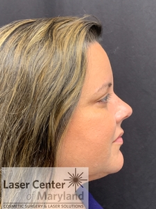 Submental Liposuction with ThermiTight-after