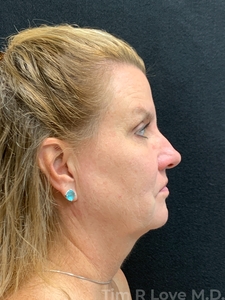 58 year old - MyEllevate, FaceTite, Morpheus8/Factora, Sculptra, Restylane Kysse-before
