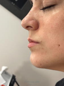 Tori Atkins RN. Volbella-before