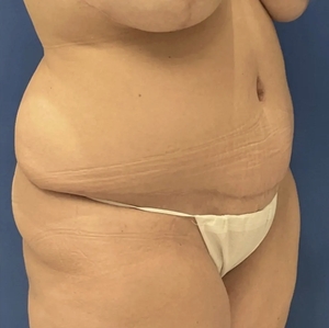 Mommy Makeover #9-after