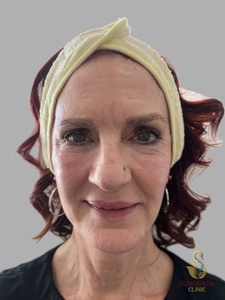 Cellenis Derma PRP 22ml, Facial balancing-before