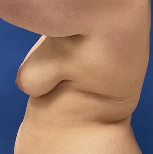 Breast Lift #5-before