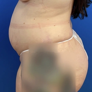 Lipo w Renuvion #8-before