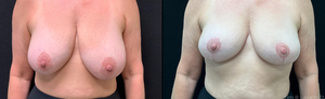 2 months post-op auto augmentation mastopexy-before