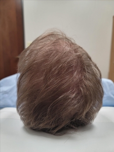 After 2nd round of Hair PRP for Plaque Psoriasis and Hair Thinning-after