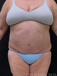 Abdominoplasty - Traditional-after