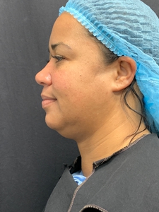 Submental Lipo + Thermitight-after