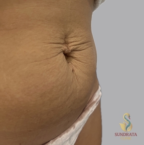 One Xerf Treatment-before