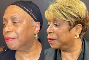 Chin filler #voluma #megan-before