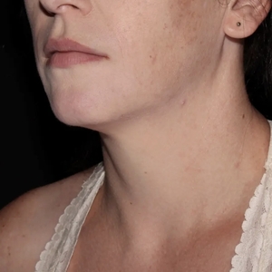 Lipo w Skin Tightening Face #4-before