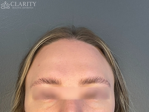 Daxxify: Frontalis-after