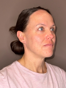 Krista Dalley- BBL face-after