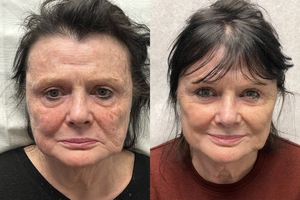 Mint Threads + filler + BBL-before