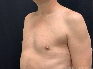2 months post BodyTite and liposuction of chest to remove gynecomastia-after