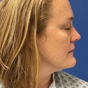 Lipo w Skin Tightening Face #7-after