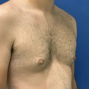 Male Breast Reduction #5 (right oblique)-before