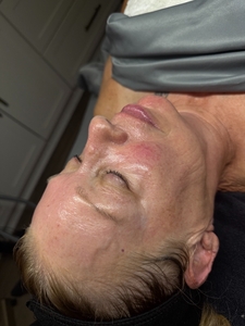 Korean Laser Glow Up Facial and Dermaplaning Add On-after