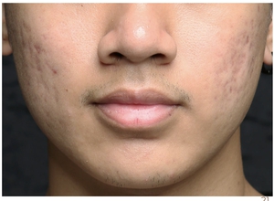 Post Acne Scars-after