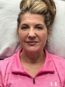 1/2 syringe of lip filler for upper lip-before