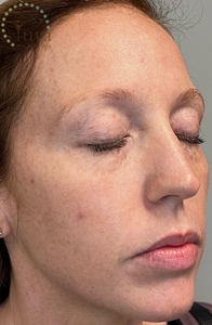 Laser skin resurfacing at Yuva-before