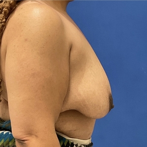Breast Lift #6-before