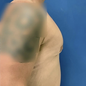 Male Breast Reduction #7-after