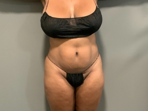 Denise Strickland Anterior-before