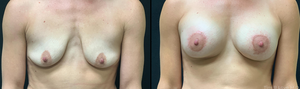 40 years old, 5'4  120lbs, 2 months post-op Mastopexy with Smooth Round Implant-before