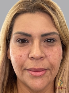 Cellenis Derma 11 ML kit, tear troughs and Cheeks-after